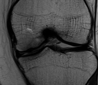 Healed OCD MRI Post ORIF